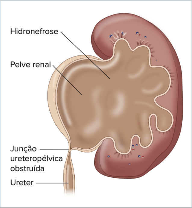 Hidronefrose - Clécio Piçarro