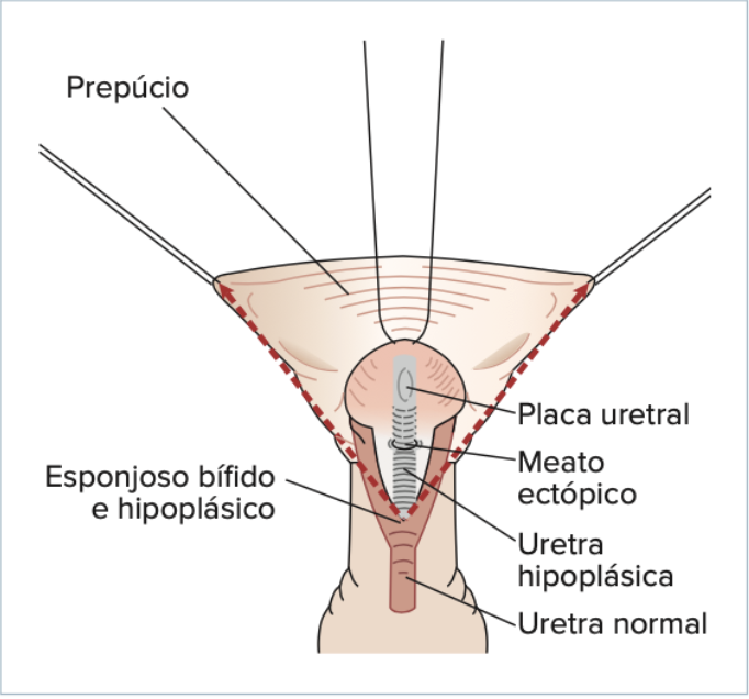 Hipospádia - Clécio Piçarro